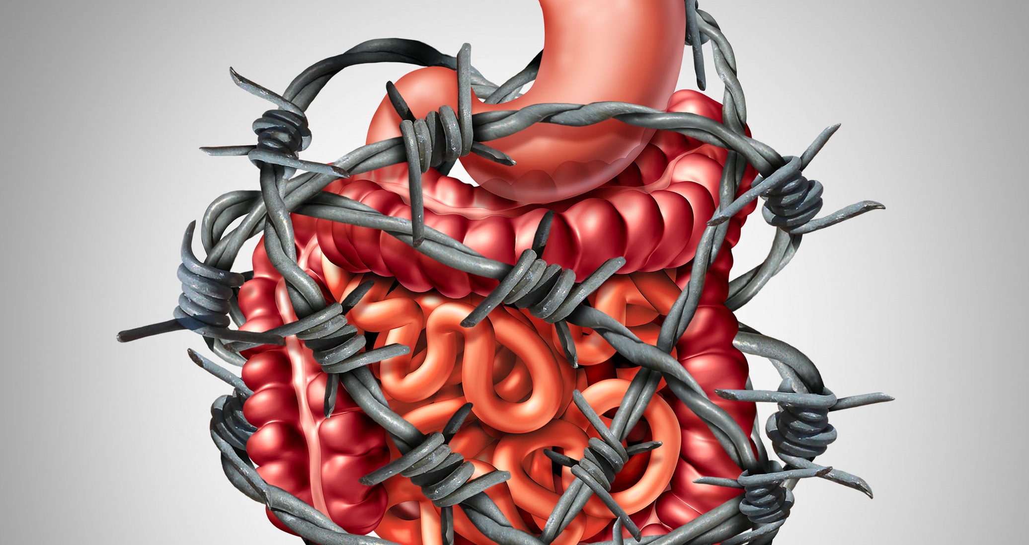 Irritable Bowel Syndrome - IBS - MedInformer