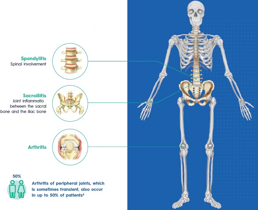 Ankylosing Spondylitis - Medinformer