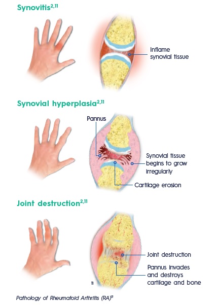 Rheumatoid Arthritis and Podiatry