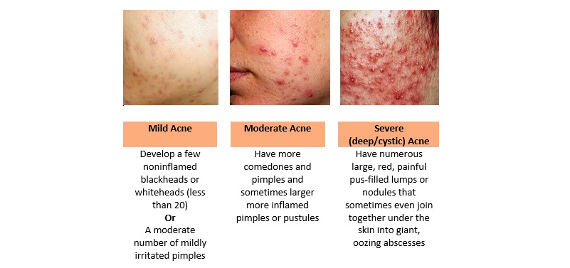 Images of mild, moderate and severe acne and pimples 