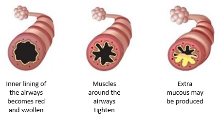 Three different airways. The first is normal, the second has tightened muscles around the airway , and the third has extra mucus present. 