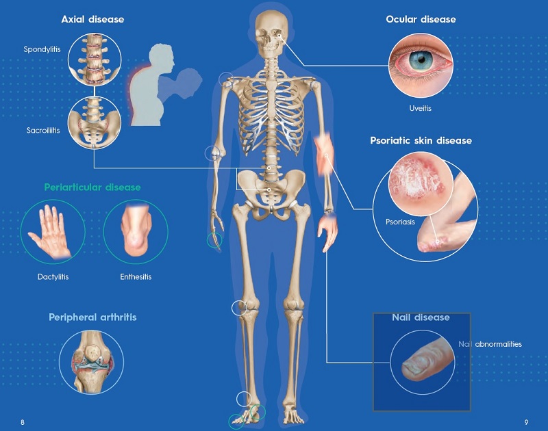 Psoriatic Arthritis Medinformer