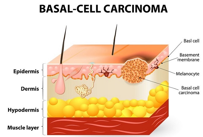 layers of the skin and the effects of basal cell carcinoma
