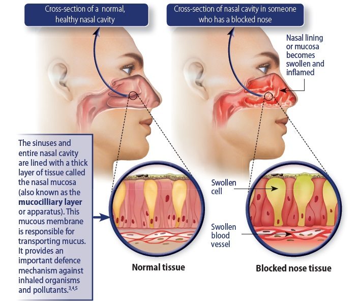 Blocked Nose Articles Dis Chem