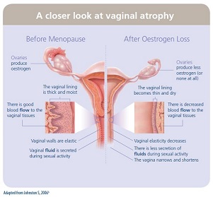 Menopause symptoms and perimenopause symptoms