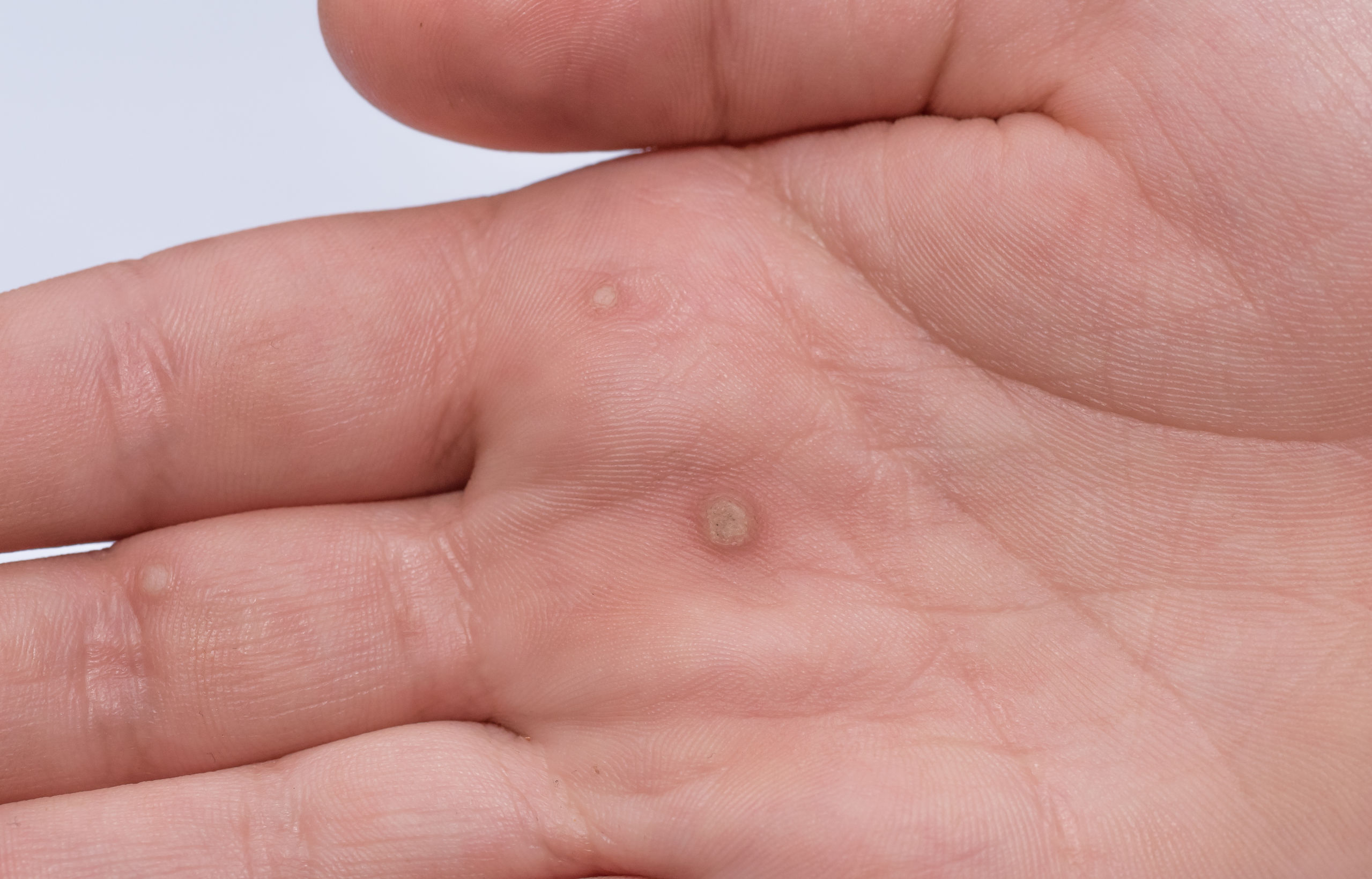 is a wart a virus or fungus